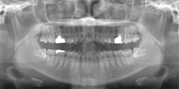 抜歯前のレントゲン