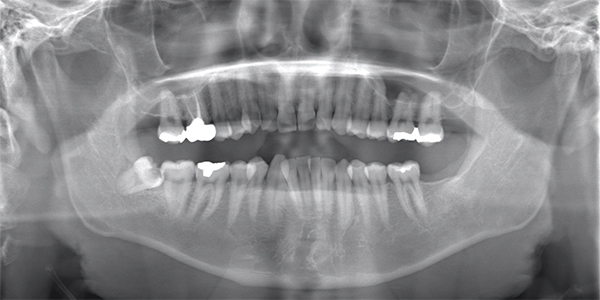 抜歯前のレントゲン